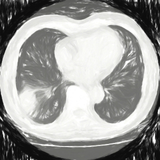 2年後の肺がん発生率をCT検査で高精度に予測するGoogleのAI