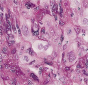 がんに必須の融合遺伝子をCRISPR遺伝子編集技術でスクリーニング