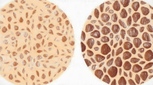 骨粗鬆症の正しい検査と最新の治療薬【骨粗鬆症の予防法も】