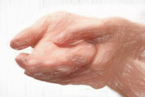 関節リウマチの症状と治療薬2019版【生命医学研究で大きく進歩】