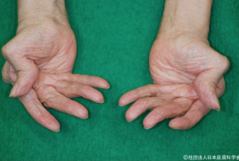 関節リウマチの合併症