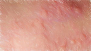 じんましんの原因と種類 【何科を受診するのか、その時の注意点】